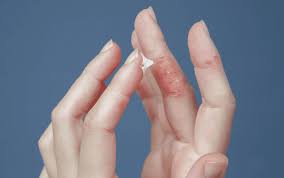 Image result for dyshidrosis