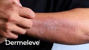 Image result for scabies effects on the human body
