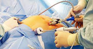 Maybe you would like to learn more about one of these? Laparoscopic Surgery Archives Ils Hospitals