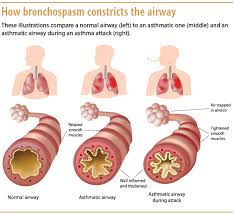 Understanding Asthma Pathophysiology Diagnosis And
