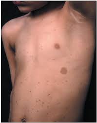 Image result for Diffuse Hyperpigmentation