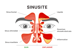 Traitement naturel de la sinusite