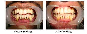 Maybe you would like to learn more about one of these? Klinik Pergigian Syarifah Faq Cuci Gigi Scaling