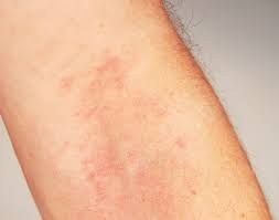 Aus wikipedia, der freien enzyklopädie. Stigmata Bei Neurodermitis Atopische Dermatitis Ein Update Zum Stand Von Diagnostik Therapie Und Pravention Arztcme
