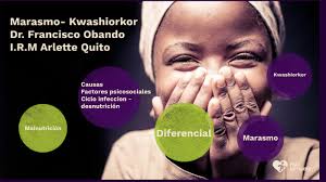 Marasmo- Kwashiorkor Arlette Quito by Arlette Quito Esteves