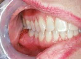 The early signs of oral cancer can be difficult to spot and therefore are sometimes easily overlooked. Oral Cancer Images The Oral Cancer Foundation