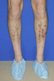 Image result for Pigment stains on the shin