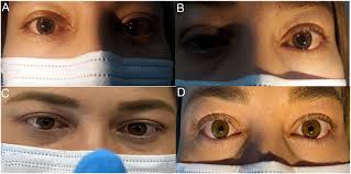 Image result for Mydriasis