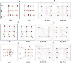 A New Interpretation And Quantitative Method For Diplopia