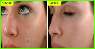How To Use Olive Oil For Acne Scars Does It Actually Work