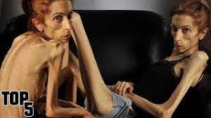 Maybe you would like to learn more about one of these? Top 5 Skinniest People In The World Youtube