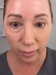 Бръчки и ботокс: Как да се справим с тях