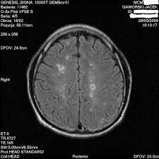Dwa jasne ogniska po lewej stronie odpowiadają obszarom demielinizacji p.grieb, l.królicki, wpaść w rezonans stwardnienie rozsiane jest jedną z najczęstszych przewlekłych i nieuleczalnych chorób neurologicznych, która na ogół diagnozowana jest między 20. Dzien Siedemnasty Nmr Jacek Gaworski Pomoz Walczyc