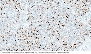 Roenigk, discusses the diagnosis and treatment of merkel cell cell carcinoma, a rare skin cancer. Pathology Outlines Merkel Cell Carcinoma