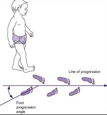 Image result for Foot Progression Angle