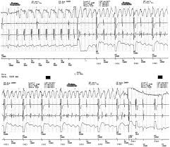 By sorin lazar, henry huang and erik wissner. Pacemaker Implantable Cardioverter Defibrillator Interaction Sciencedirect