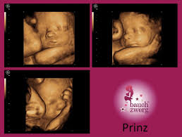 Ssw lassen in 3d nicht mehr viele details erkennen. 3d Ultraschall Ssw Bauch Weg Ultraschall