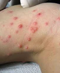 Molusco Contagioso: Tratamento com Óleos Essenciais - Óleos Essenciais | O  Guia do Brasil