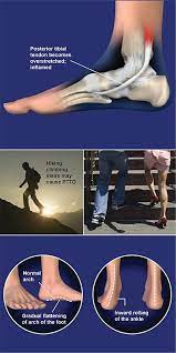 Stage ii disease often involves pain medially along the tendon early on, with later subfibular impingement and sinus tarsi pain; Posterior Tibial Tendon Dysfunction Pttd Central Coast Orthopedic Medical Group