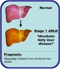 There are several stages of severity and a range of associated the national institute on alcohol abuse and alcoholism defines heavy drinking as drinking five or more drinks in one day on at least five of the. Happy New Year I D Give Your Liver Just Two Weeks Histology Blog