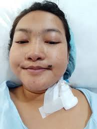 USAPANG KIDNEY AND KIDNEY STONES