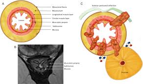 Signs and symptoms are sometimes elusive, but historical studies show that up to 20% of colorectal cancers occur in the cecum (in some studies it is much less common). Rectal Cancer Lexicon Consensus Statement From The Society Of Abdominal Radiology Rectal Anal Cancer Disease Focused Panel Springerlink