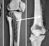 Medial Plating of Distal Femoral Fracture with Locking ...