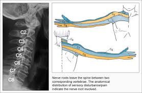 Pin On Neck Pain Relief
