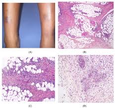 Image result for Panniculitis