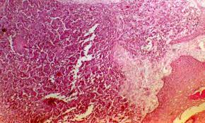 Merkel cell carcinoma treatment options include surgery, radiation therapy, and chemotherapy. Histopathology Showing Merkel Cells Arranged In Rosettes With Mitoses Download Scientific Diagram