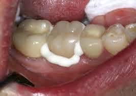 How much does it cost? Dental Crowns Dentist On Main Dentist Cape Town