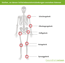 Schleimbeutelentzundung Ursachen Symptome Behandlung Der Bursitis