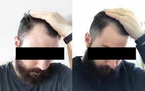 Rogaine can even reverse the. Propecia Vs Rogaine Finasteride Vs Minoxidil Which Hair Loss Treatment Is Right For You