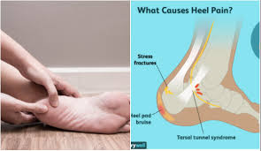 Plantar fasciitis adalah peradangan pada jaringan penghubung antar tulang (ligamen) di telapak kaki, tepatnya di antara tumit dan lengkungan kaki. Ngilunya Bila Berjalan Ini Sebab Kenapa Anda Selalu Sakit Tumit Jangan Biarkan Melarat