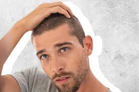 the best hair loss treatments for men