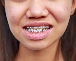 How to correct underbite without surgery. Underbite Causes Symptoms And Treatment Options
