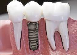 With a voucher for dental implants, you can afford to look a million dollars. Affordable Dental Implants Dental Implants From 495 Dent1st Cosmetic Dentistry Dental Implant Centre