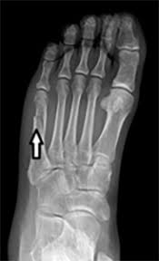 Metatarsal Fracture Orthopaedic Trauma Association Ota