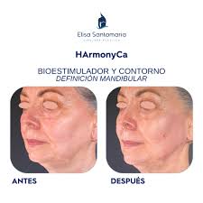 HArmonyCa es un tipo de relleno dérmico que combina ácido hialurónico e  hidroxiapatita de calcio. Este tratamiento inyectable tiene un potente  efecto en la bioestimulación del colágeno de la piel, mejorando la