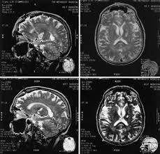 Image result for Pallidotomy