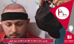 فیلم و عکس کندن دلمه های کاشت مو