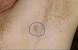 Ingrown Hair Underarm Boil