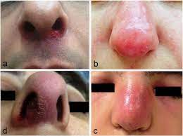 Causes, symptoms, treatment and prevention alkaline foods chart increasing your high alkaline food intake along with a healthy lifestyle may greatly reduce. Nasal Vestibulitis Etiology Risk Factors And Clinical Characteristics A Retrospective Study Of 118 Cases Sciencedirect