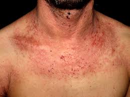 Resultado de imagen para DERMATITIS ATOPICA