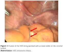 Meaning, you can easily get pregnant after getting it removed. Intrauterine Contraceptive Device Embedded In The Omentum Case Ijwh