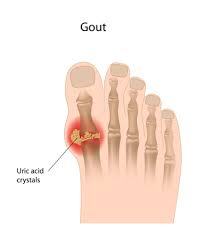 Image result for gout symptoms toe