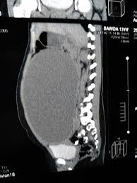 Mesentric Peritoneal Inclusion Cyst Radiology Cysts Cavities