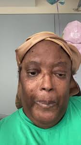 Blind in right eye after craniotomy to temove aneurysm. Was it worth i...