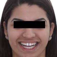 Incisão em bisel interno.