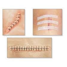 Here we discuss the equipment required, principles of. Que Faire Si Je M Ouvre Un Point De Suture 5 Etapes